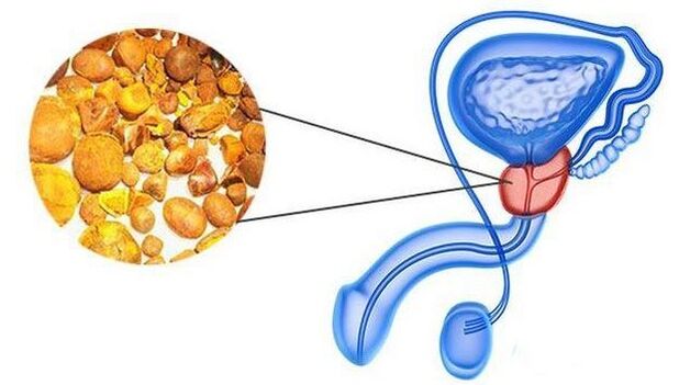 Count in the prostate gland