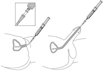 Instill a drug solution in the urethra