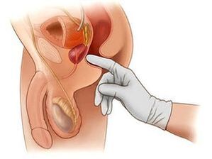 prostate sequence for prostatitis