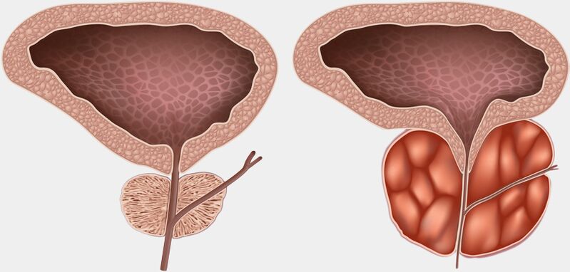 healthy prostate and inflamed with prostatitis