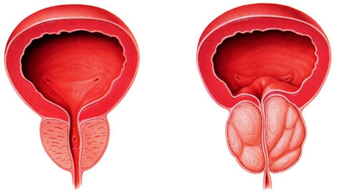 healthy prostate and inflamed with prostatitis