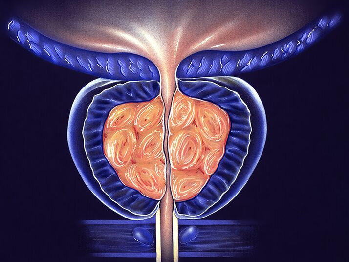 inflamed prostate and prevention of prostatitis