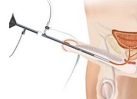 injections for prostatitis