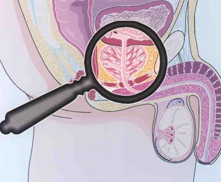 Defeat of prostate tissue in patients with male chronic prostatitis