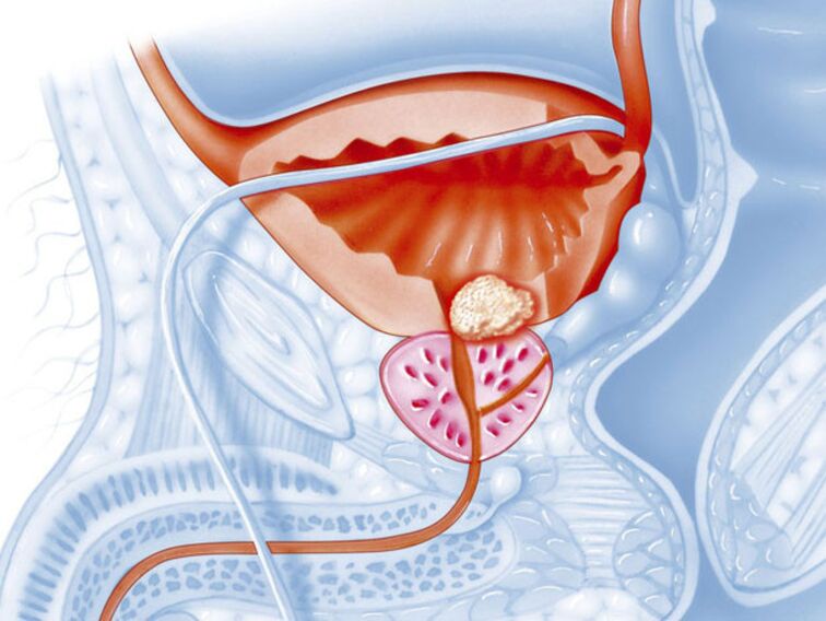 In chronic prostatitis, the lumen of the urethra narrows, which makes it difficult for urine to flow out. 