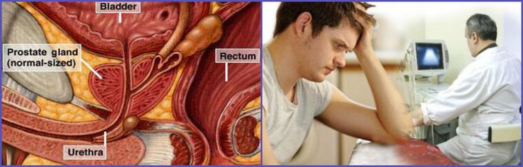 To diagnose chronic prostatitis in men, an ultrasound of the prostate gland is performed. 